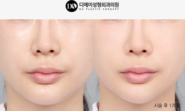Before/After