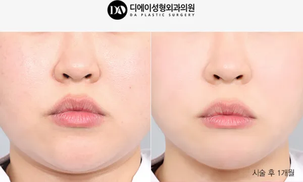 Before/After