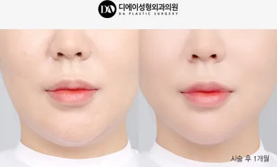 Before & After