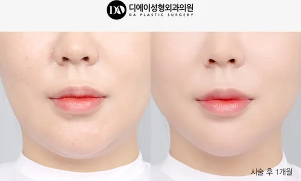 Before/After