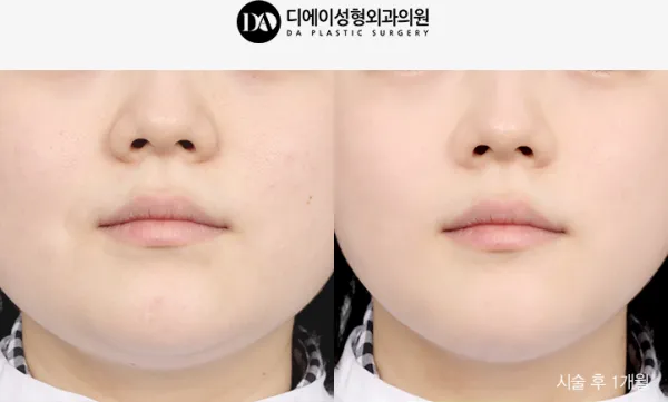 Before/After