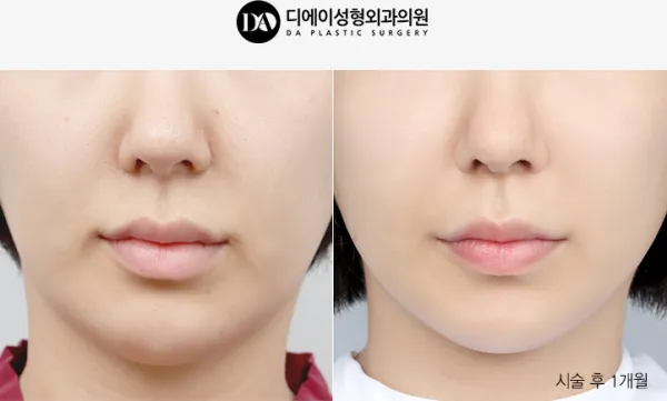 Before/After