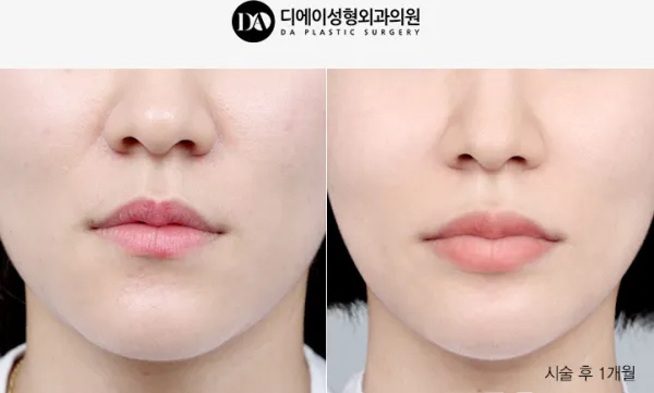 Before/After