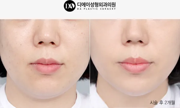 Before/After