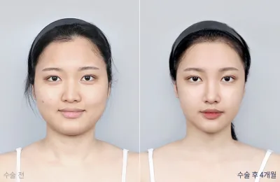 Before & After