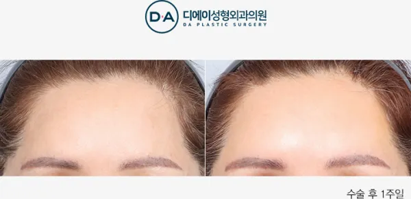 Before/After