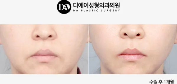 Before/After