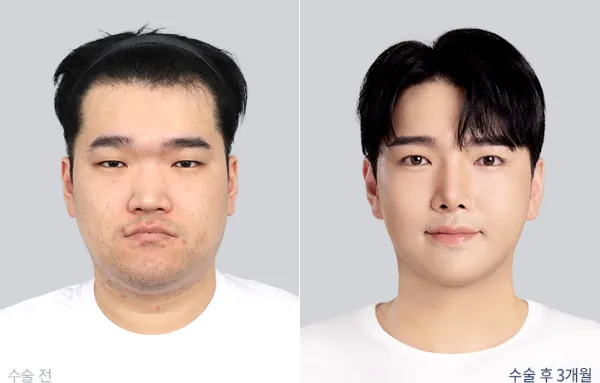 Before/After