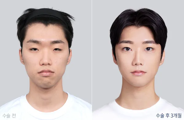 Before/After