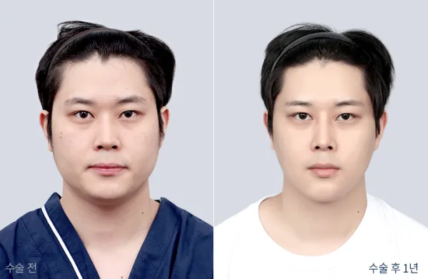 Before/After