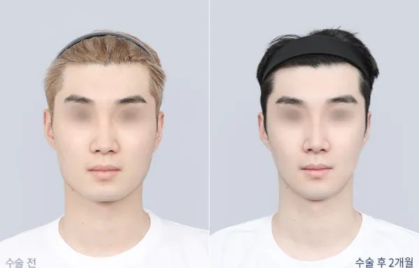 Before/After