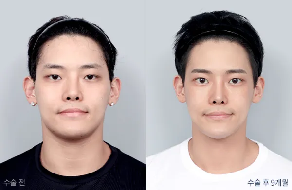 Before/After