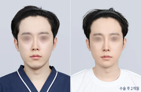 Before/After