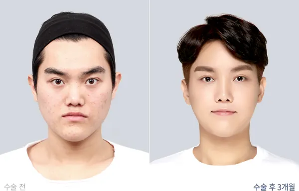 Before/After