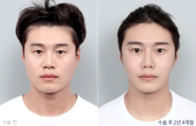Before & After