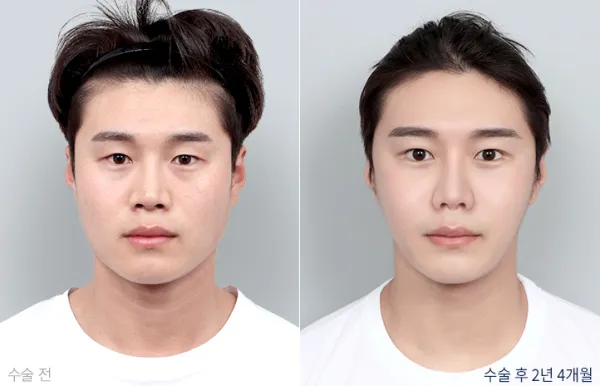 Before/After