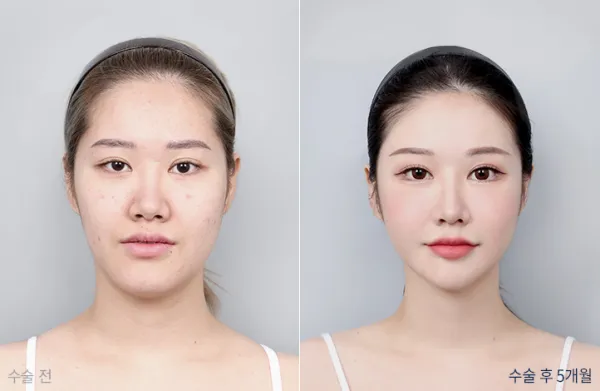 Before/After