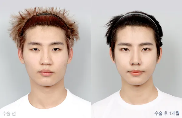 Before/After