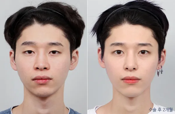 Before/After
