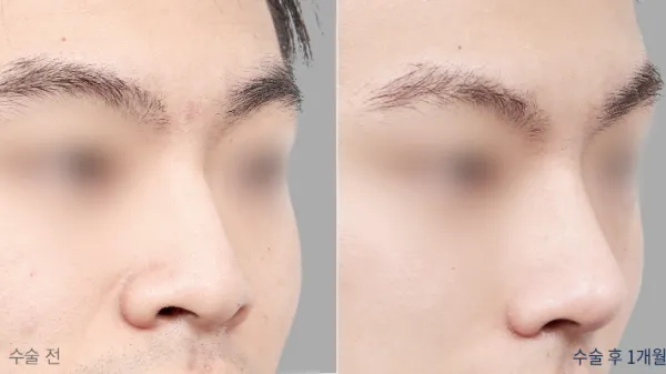 Before/After