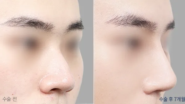 Before/After
