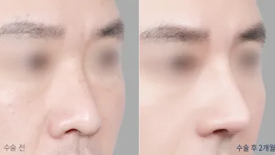 Before & After