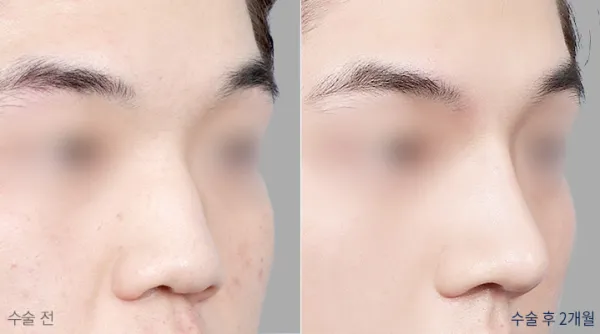Before/After