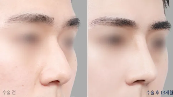Before/After