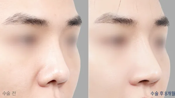 Before/After