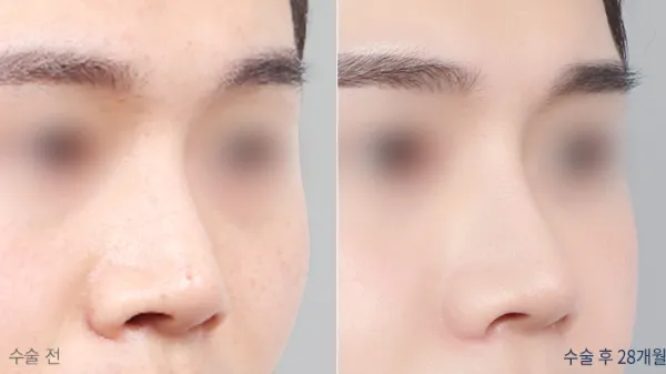 Before/After