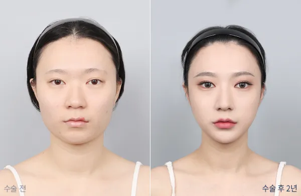 Before/After