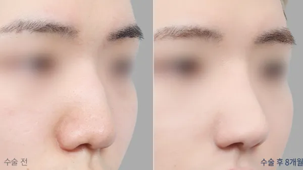 Before/After