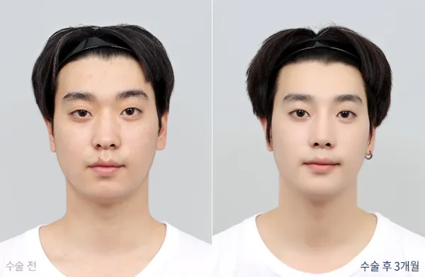 Before/After