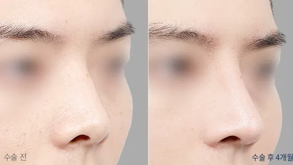 Before/After