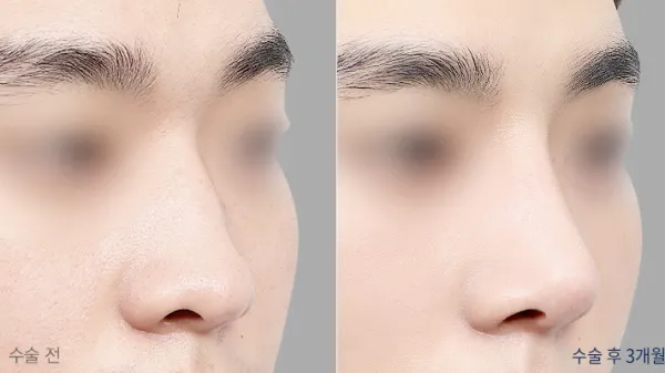Before/After
