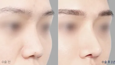 Before & After
