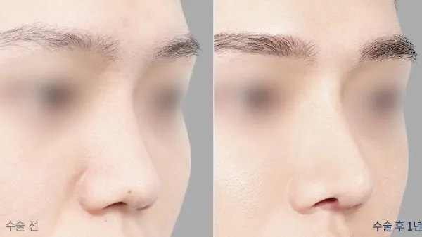 Before/After