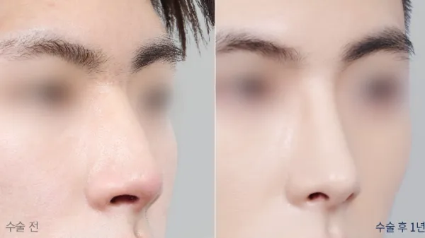 Before/After