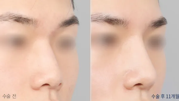 Before/After