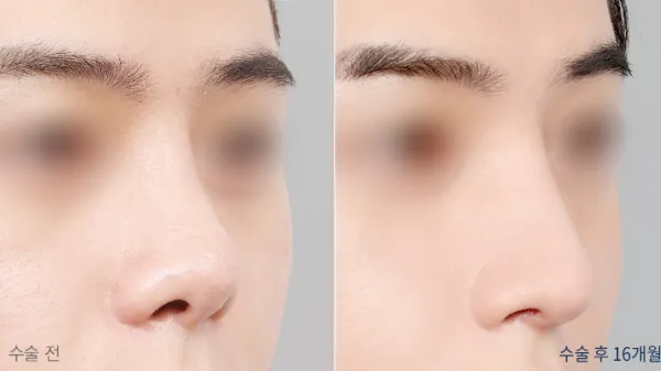 Before/After