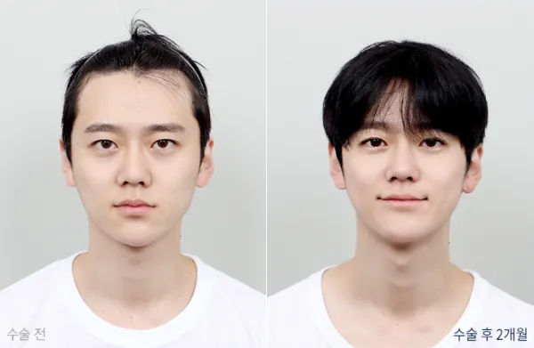 Before/After