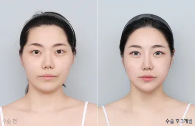Before & After