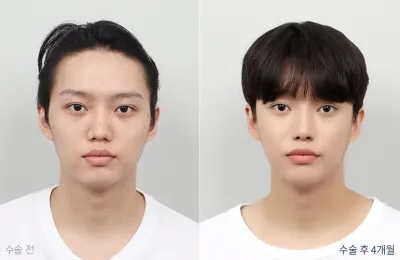Before & After