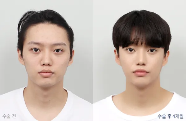 Before/After