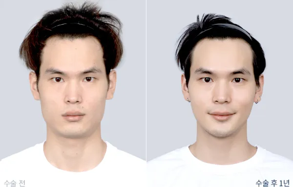 Before/After