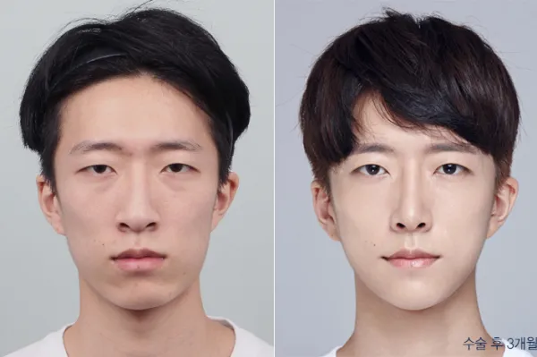 Before/After