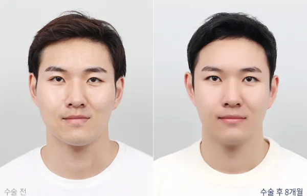 Before/After