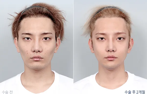 Before/After