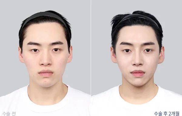 Before/After