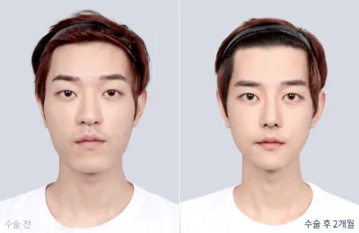 Before & After